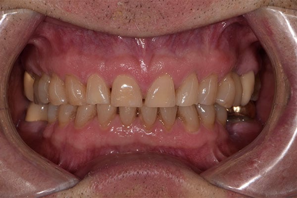 FMR1-before Full Mouth Rehabilitation before smile