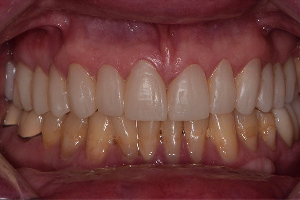 FMR2-after Full Mouth Rehabilitation after smile