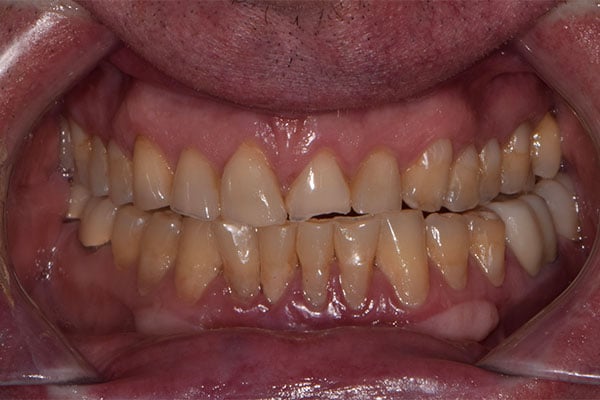 FMR2-before Full Mouth Rehabilitation before smile