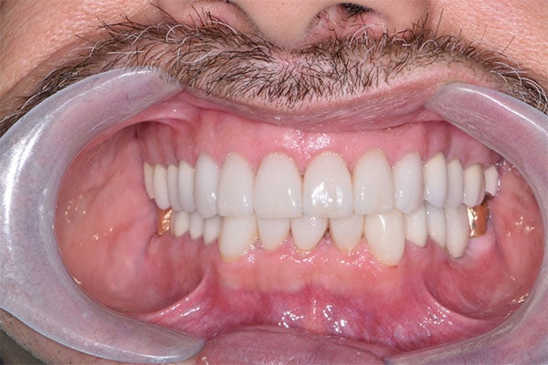 FMR3-after Full Mouth Rehabilitation after smile