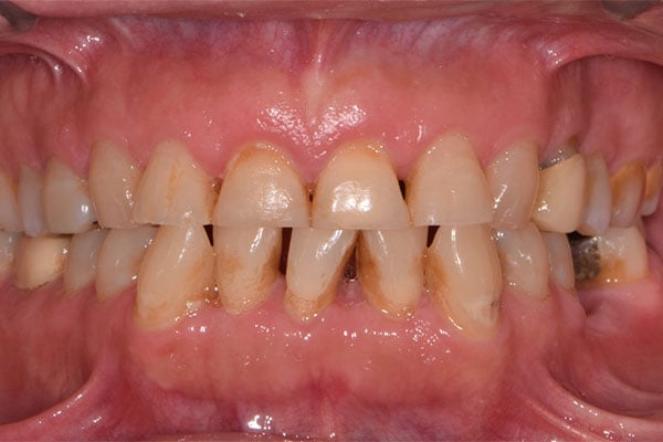 FMR3-before Full Mouth Rehabilitation before smile