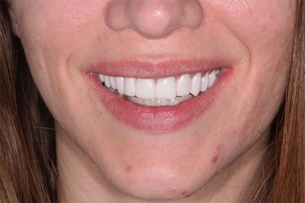 FMR4-after Full Mouth Rehabilitation after smile