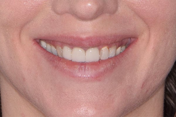 FMR4-before Full Mouth Rehabilitation before smile