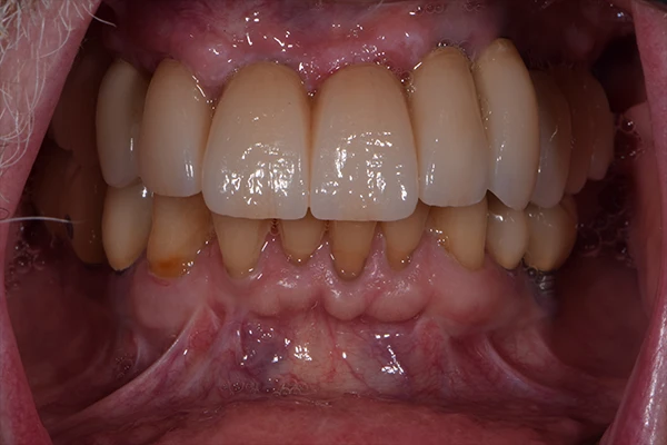 ImplantBridge1-after Implant Bridge After