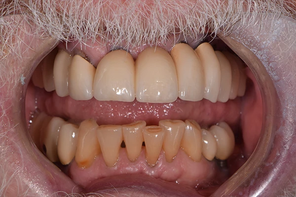 ImplantBridge1-before Implant Bridge Before