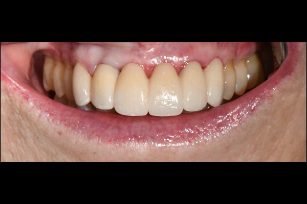 ImplantBridge2-after Implant Bridge After