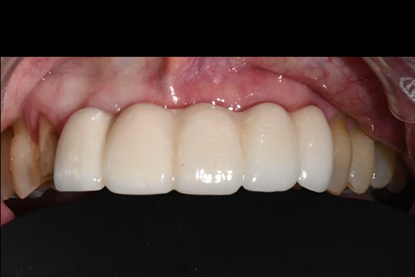 ImplantBridge2b-before Implant Bridge Before