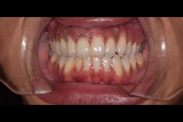 ImplantCrown1-after Implant Crown after smile
