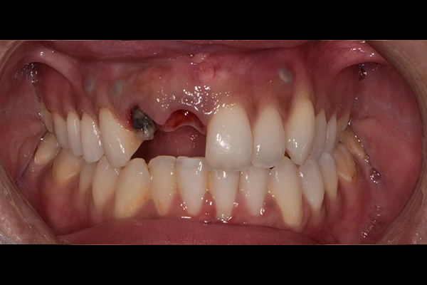 ImplantCrown1-before Implant Crown before smile