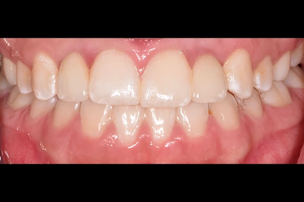 ImplantCrown2-after Implant Crown after smile