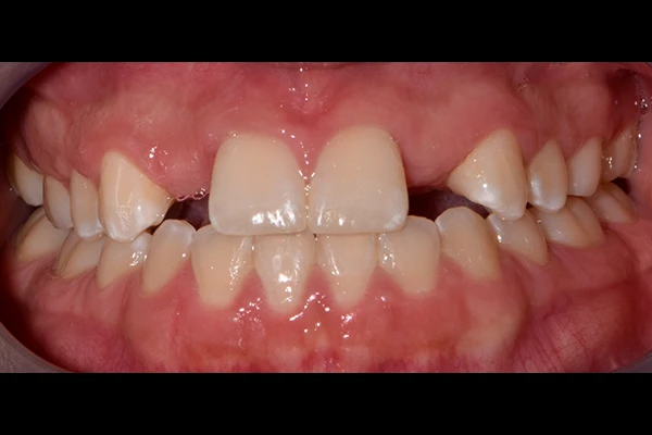 ImplantCrown2-before Implant Crown before smile