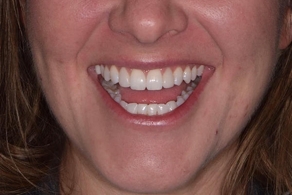 Veneers-After-1 Veneers after Smile