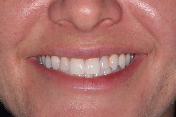 Veneers-Before-1 Veneers before smile