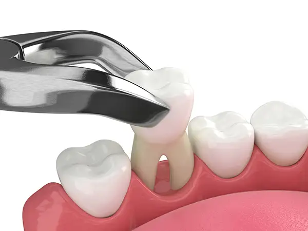 A dental tool extracting a tooth from the lower gum line, highlighting oral anatomy during the procedure. A dental tool extracting a tooth from the lower gum line, highlighting oral anatomy during the procedure.