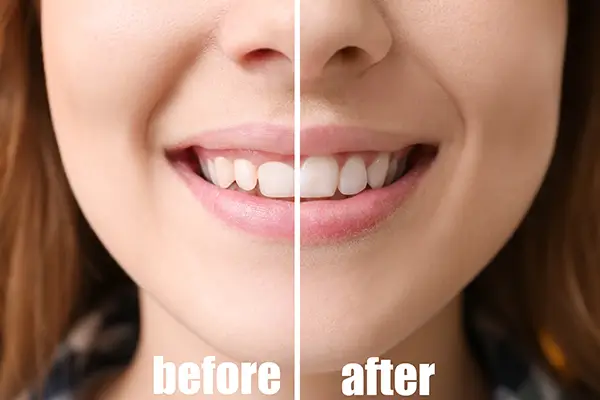 Before and after comparison of a woman’s smile showing improved gum contour after gingival contouring.